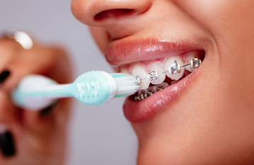 Брекеты. Как чистить брекеты. Питание